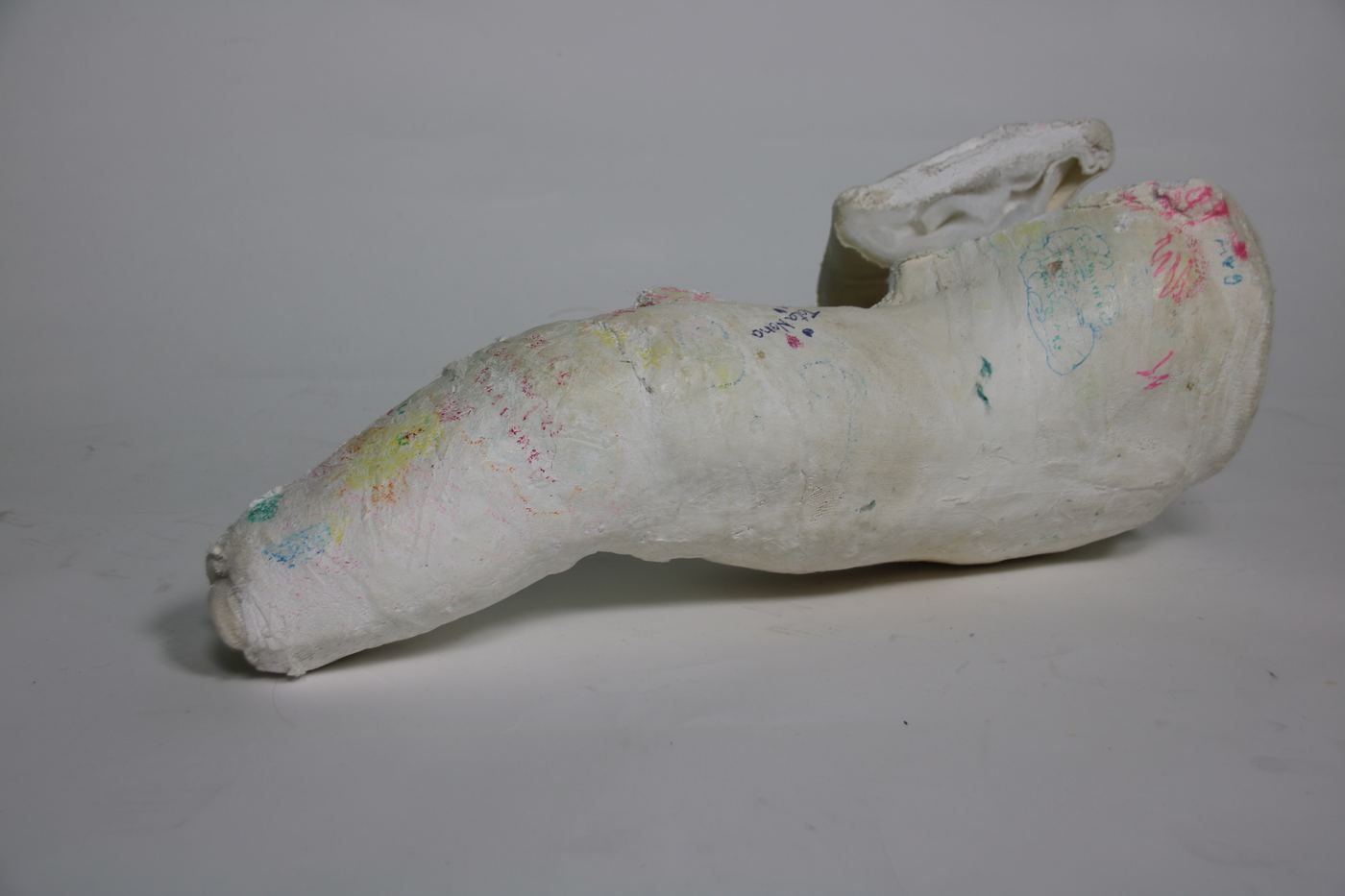 Traditional plaster spica cast